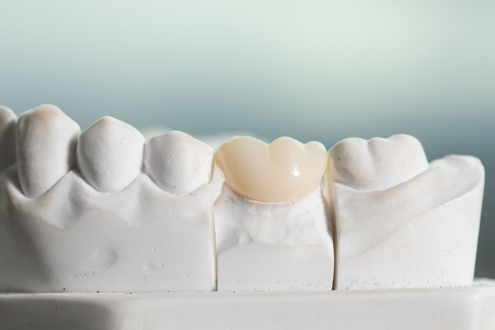 Dental crown - 3Dental